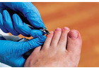 Kick Fungus to the Curb: Quick Guide to Onychomycosis (Toenail Fungus)
